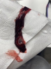 Miscarriage or blood clot?