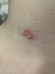 What is this rash?