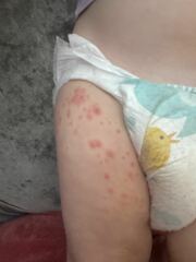 What do you think this rash is?