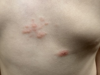 Sudden itchy rash - allergy? Shingles? Bed bugs? Help!