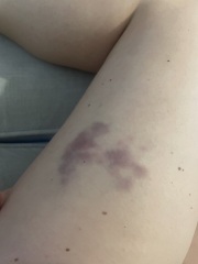 Massive bruise after scratching
