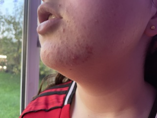 13 year old daughter’s skin
