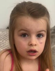 Haemangioma/propranolol