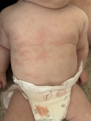 Simply dry skin, or a rash?