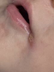 Cold sore, angular cheilitis or other?