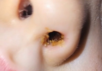 Adenoidectomy- nose discharge