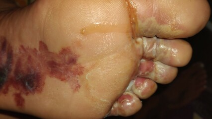 Shamelessly posting for traffic. Medical question and im definitely AIBU for posting disgusting pictures looking for answers