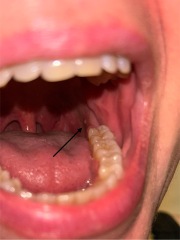 Long-term very small, painless growth or lump inside mouth/throat