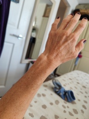 Angelina Jolie, treatment for hand veins?