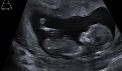 Boy or Girl? 12 week scan