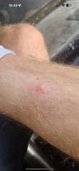 Is this a bite?