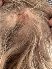 What are these marks on my daughter?