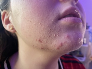 13 year old daughter’s skin