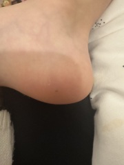Something stuck in child’s foot… pic attached!!
