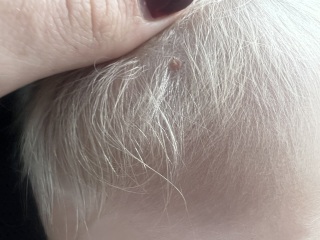 Skin tag? Worried mummy