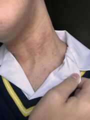 Help Please. Allergic Reaction!