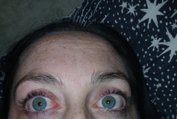 Sore eyes
