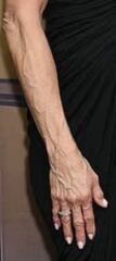 Angelina Jolie, treatment for hand veins?