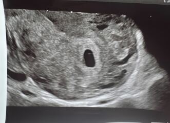 ultrasound scan 5w4d