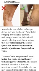 This vein treatment?