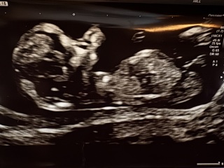 Girl or boy nub?? Gender prediction/guesses