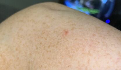Is this a skin tag?
