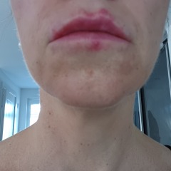 Spots round mouth