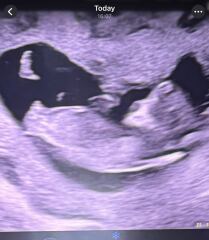 Gender prediction/nub theories please!