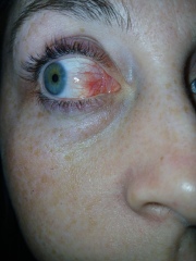 Sore eyes