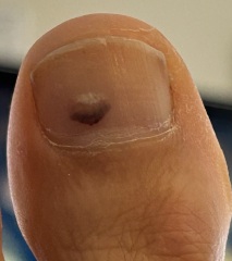 this could be subungual melanoma