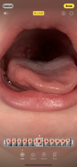 White spots on breastfed baby throat - Milk curds?