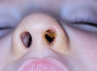 Adenoidectomy- nose discharge