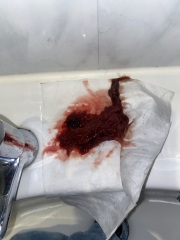 Blood clots