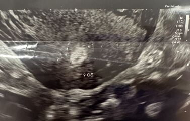 ultrasound scan 5w4d