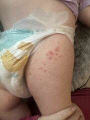 What do you think this rash is?
