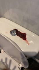 Blood clots