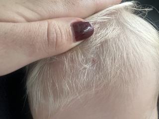 Skin tag? Worried mummy