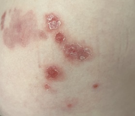 What is this rash?