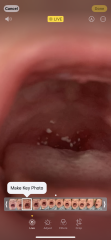 White spots on breastfed baby throat - Milk curds?