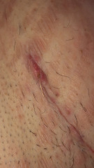 lochia/post partum bleeding helppp