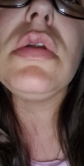 Facial puffiness/swelling  - photos included