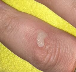 This is a semi normal burn, right?