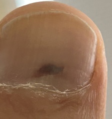 this could be subungual melanoma