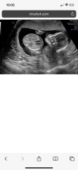 Does my baby’s face on ultrasound look normal?