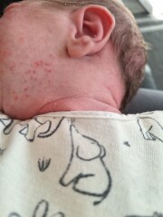 Is this baby acne??