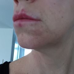 Spots round mouth