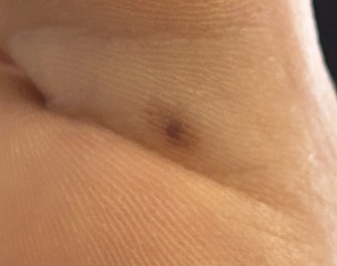 this could be subungual melanoma