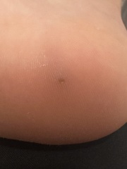 Something stuck in child’s foot… pic attached!!
