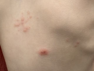 Sudden itchy rash - allergy? Shingles? Bed bugs? Help!