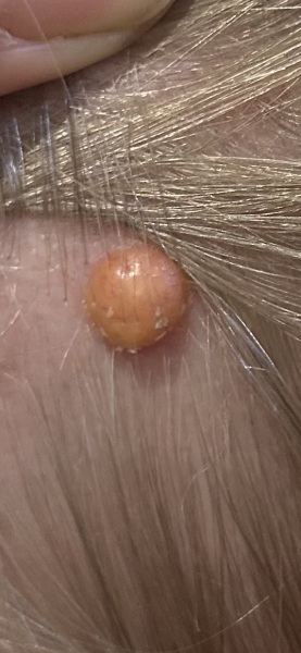 What is this alien life form? (Dr says nowt to worry about but it keeps growing and getting more sore).